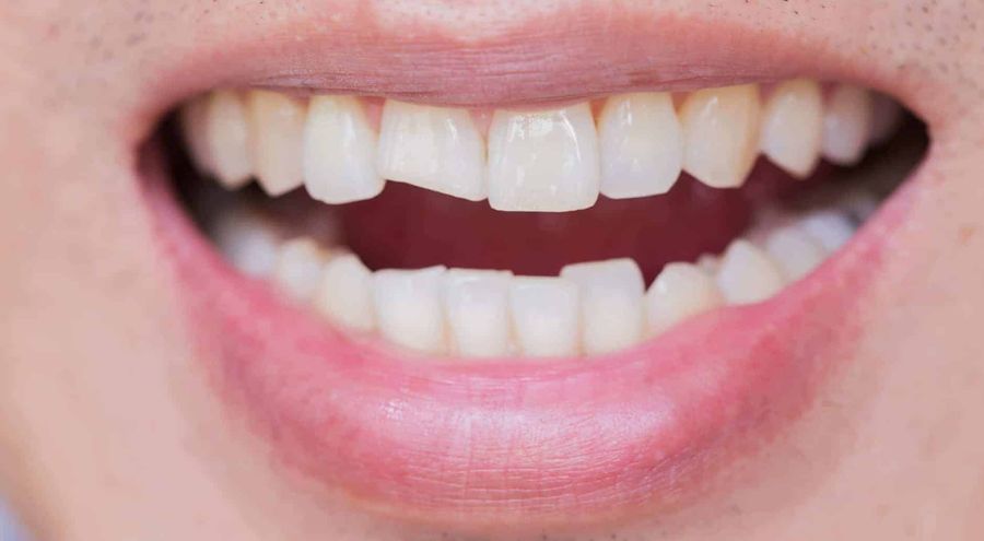 How to repair a chipped tooth?