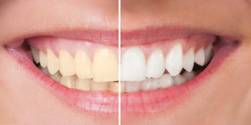 Tooth whitening procedure