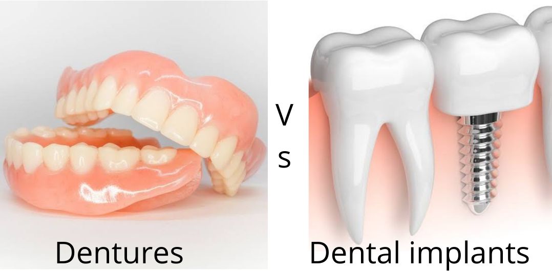 Implant-supported dentures cost and care