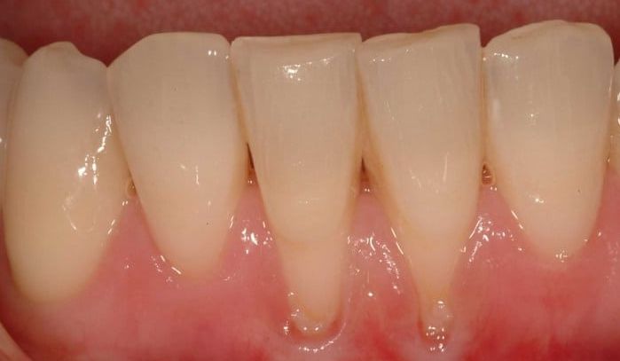 Gingival recession: Receding gums and what you can do about it?