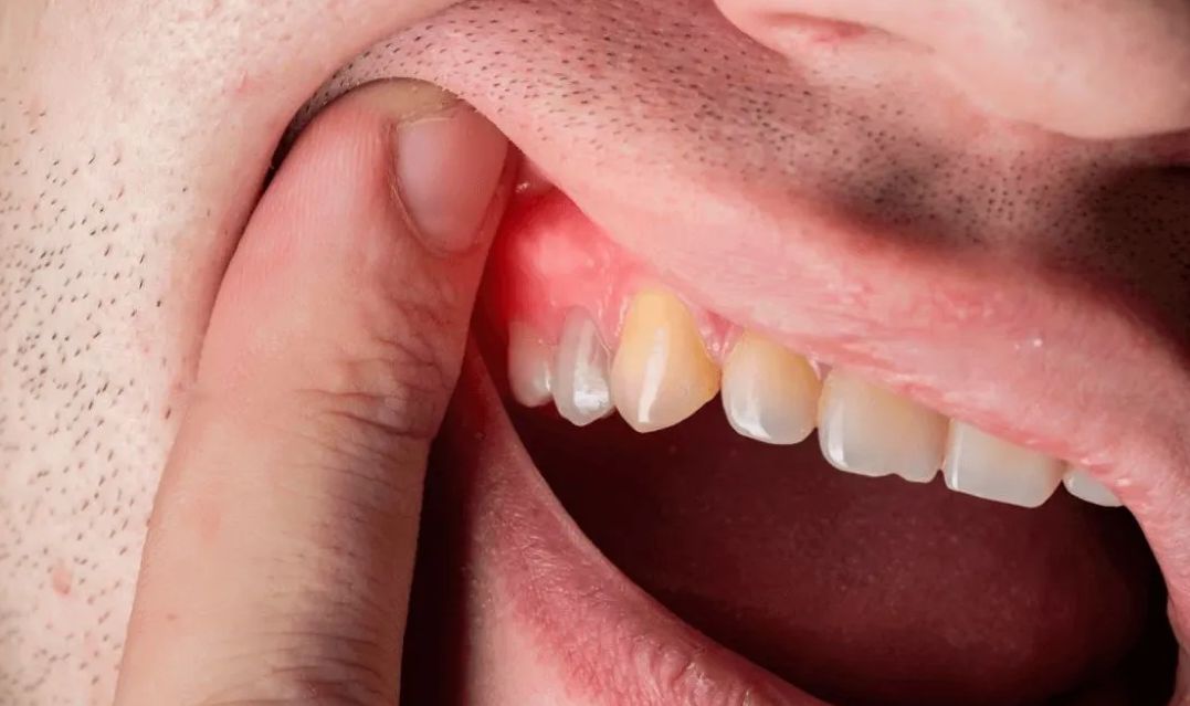 How to treat sensitive teeth problem?