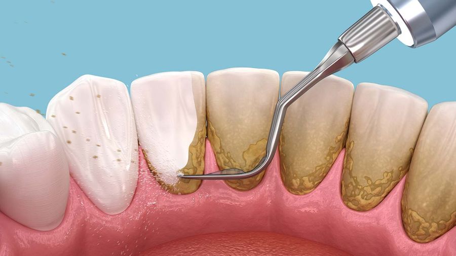 Tartar removals - what you need to know