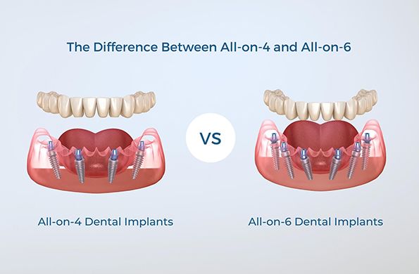 All-on-4 vs All-on-6 dental implants comparison diagram showing full arch restoration with four and six implants for dental tourism patients