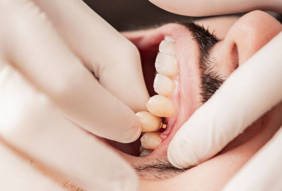 Dental implants supported dentures in Budapest dental dentistry: long term solution to missing teeth: dental omplant placement in our dental surgery