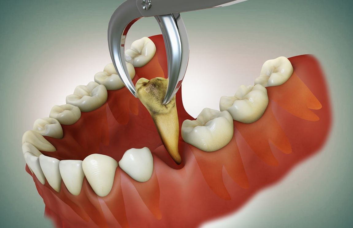 Find out more about having teeth extracted, including how to prepare, what's involved and after care advice