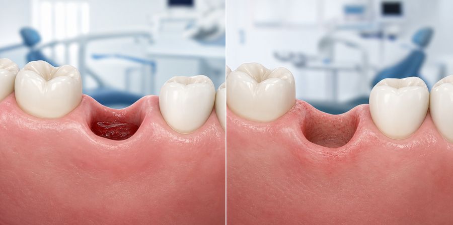 Illustration comparing a healthy blood clot after tooth extraction with dry socket alveolitis sicca